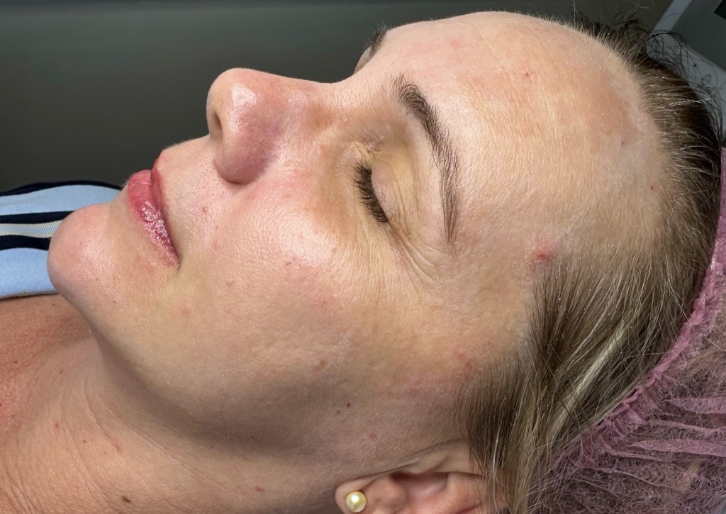 Tratamento com Laser Lavieen para melhora da textura e luminosidade da pele.