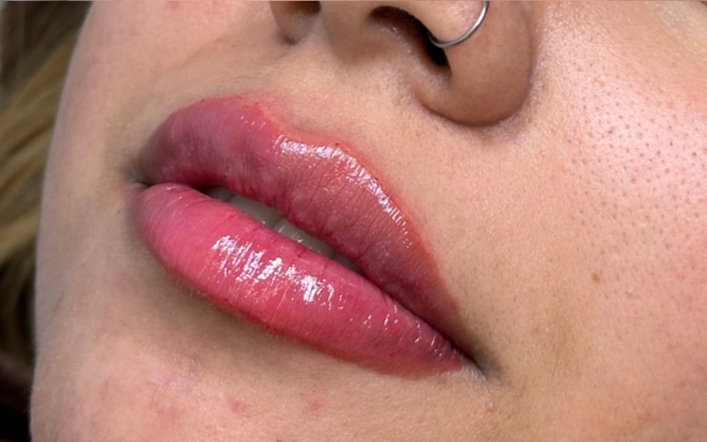 Procedimento de harmonização labial com resultado natural e proporcional.
