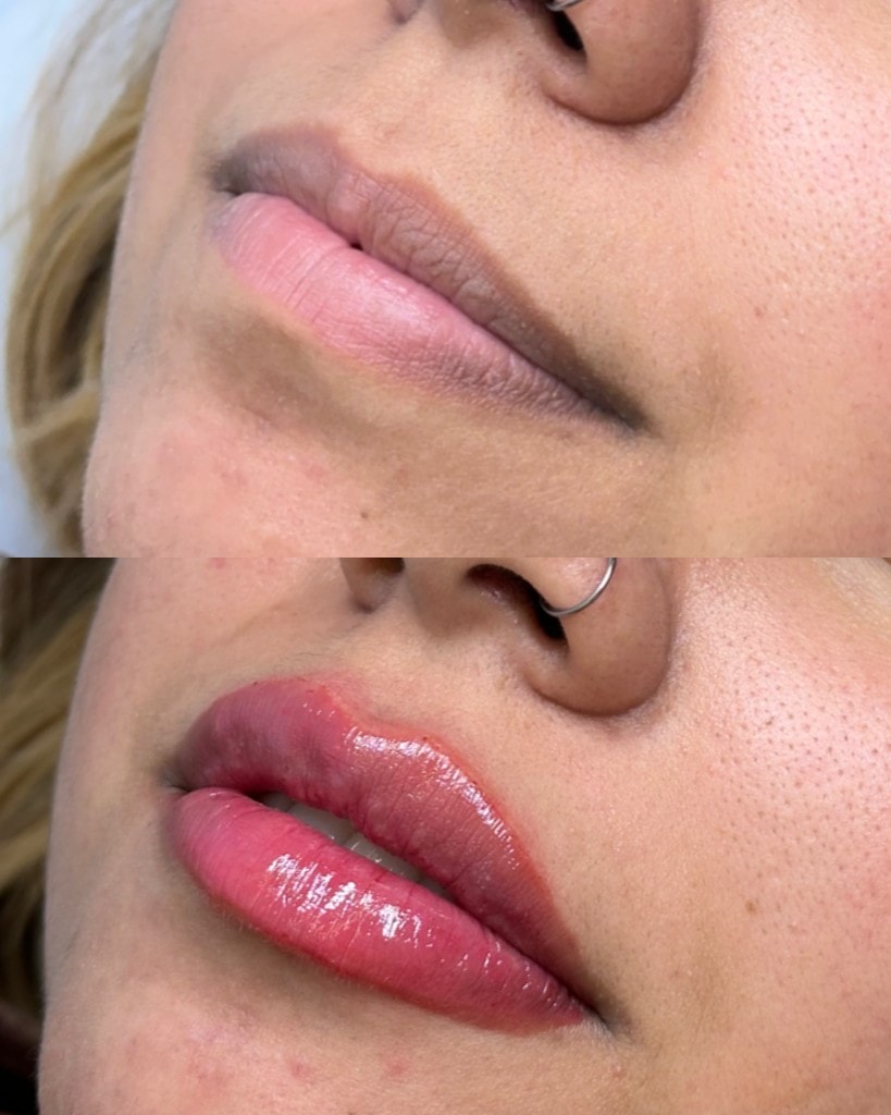 Comparativo antes e depois do preenchimento labial com resultado natural e proporcional.
