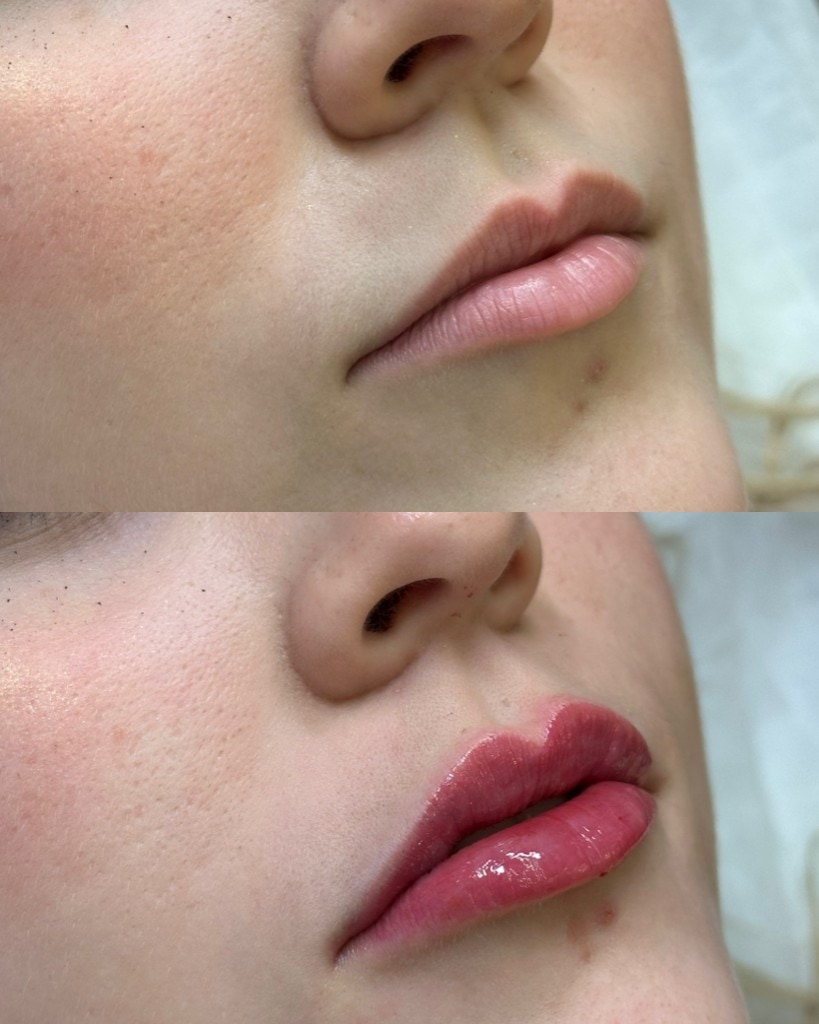 Procedimento de preenchimento labial realizado com planejamento e cuidado.