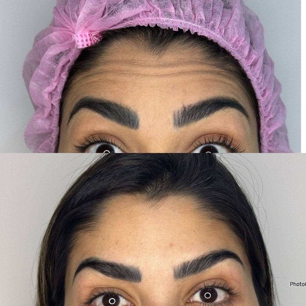 Comparação antes e depois de Botox com suavização de linhas de expressão na testa.