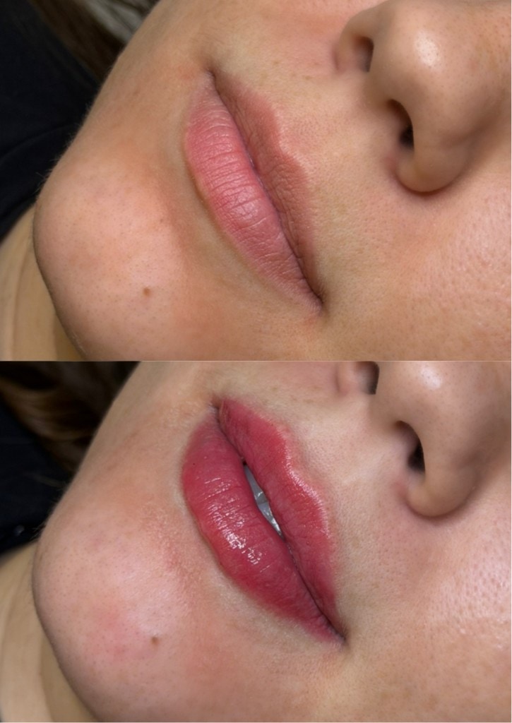 Comparação antes e depois de preenchimento labial com realce natural do contorno.
